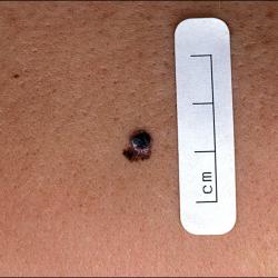 Example of skinCancerAndMelanomas
